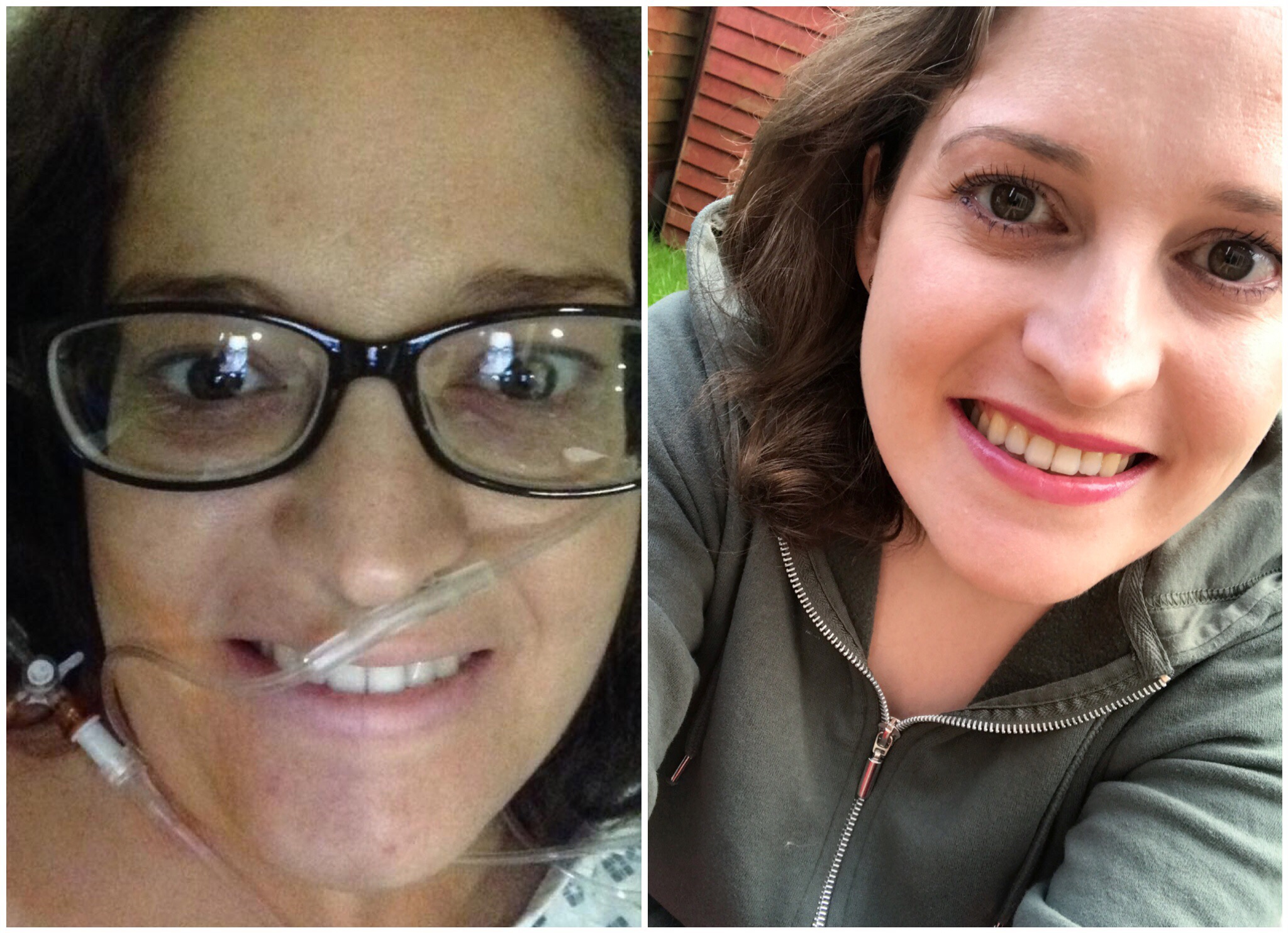 Me on the day of my transplant, and on the first anniversary.